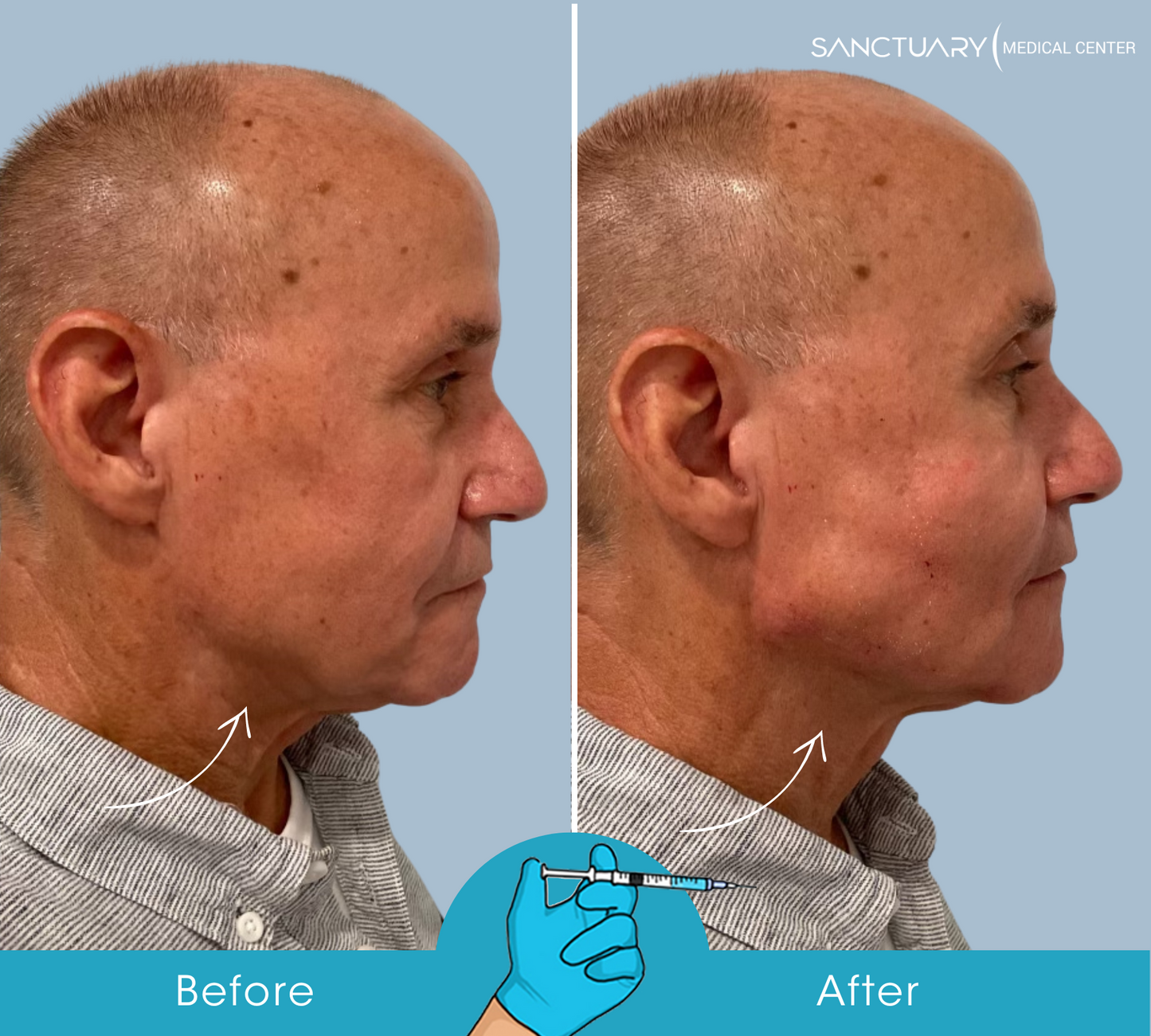 Juvederm Fillers (MM)