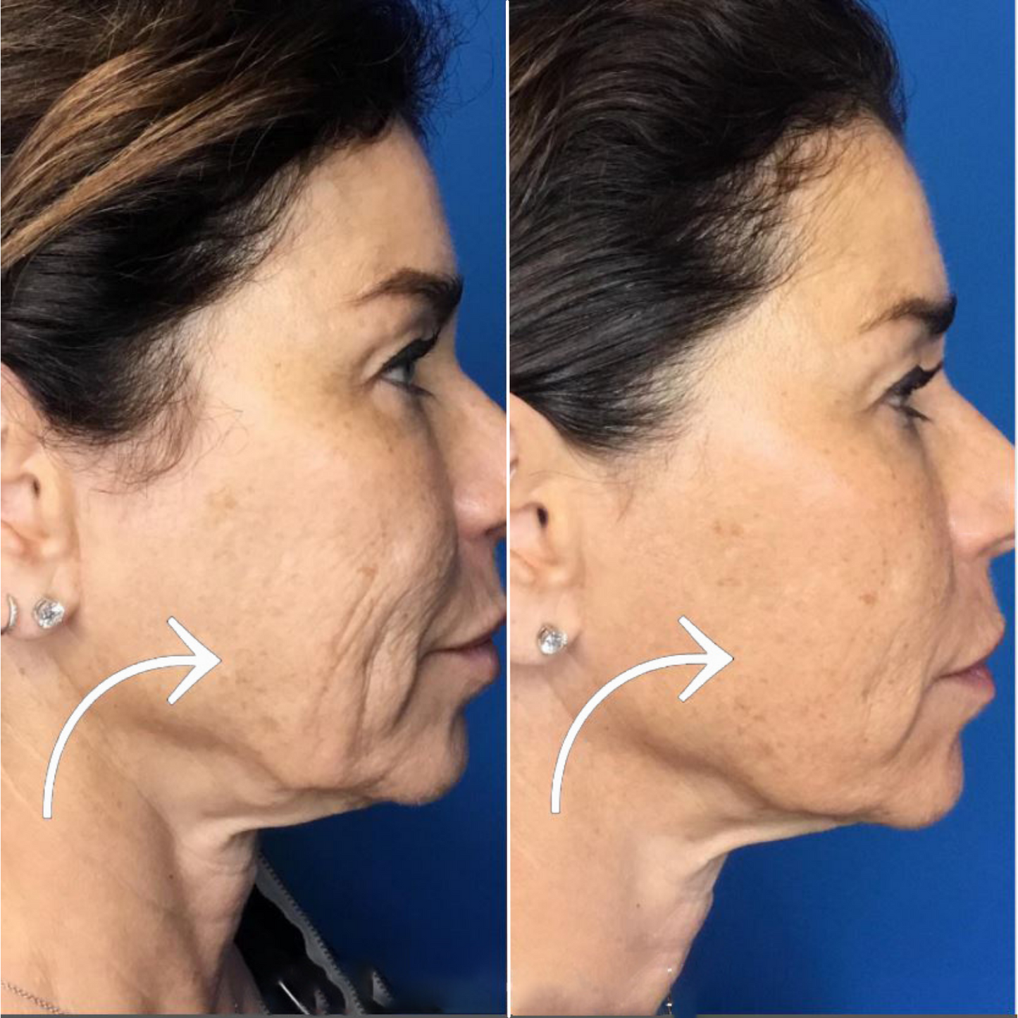 Genius Fractional RF Microneedling (MM)