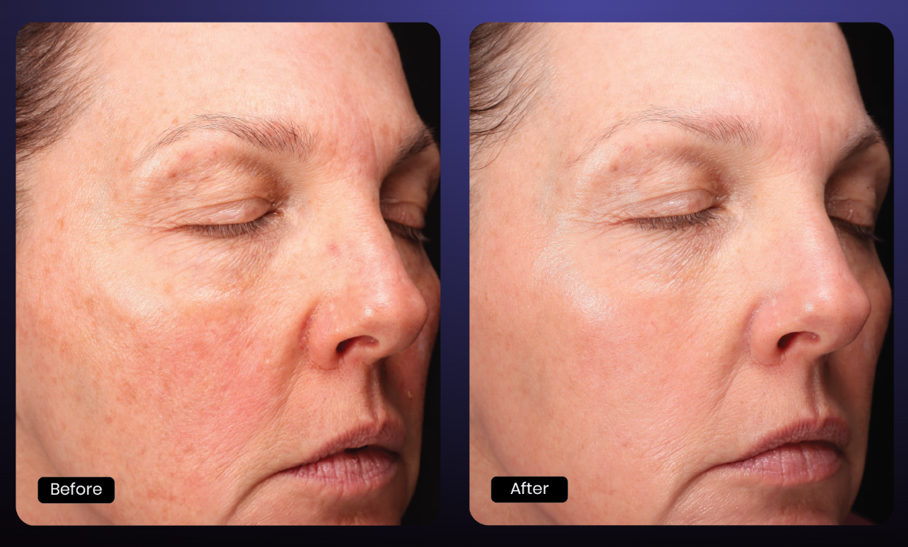 Halo Tribrid Laser (MM)