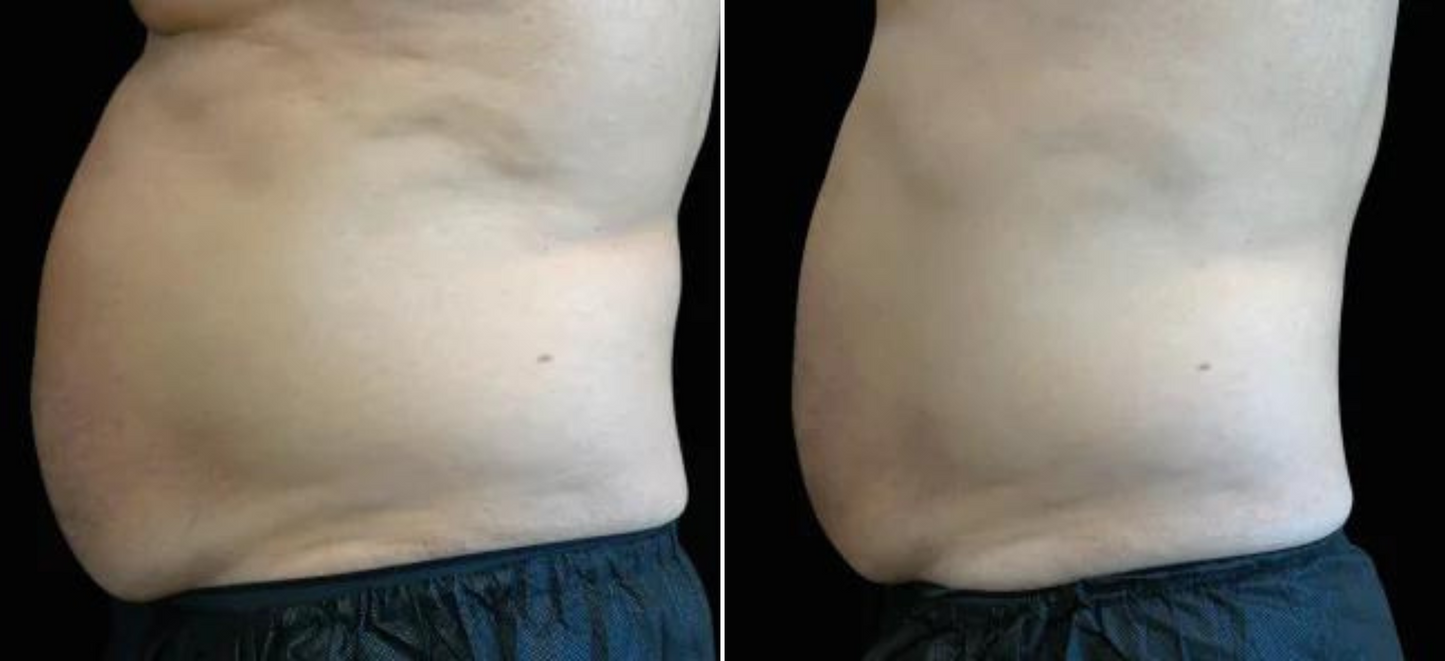 EMSculpt Neo Online Exclusive (MM)