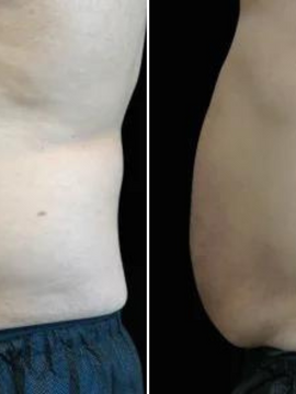 EMSculpt Neo Online Exclusive (MM)