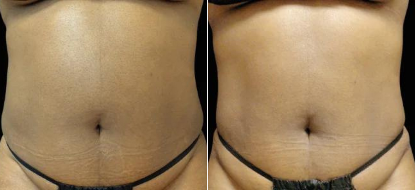 EMSculpt Neo Online Exclusive (MM)