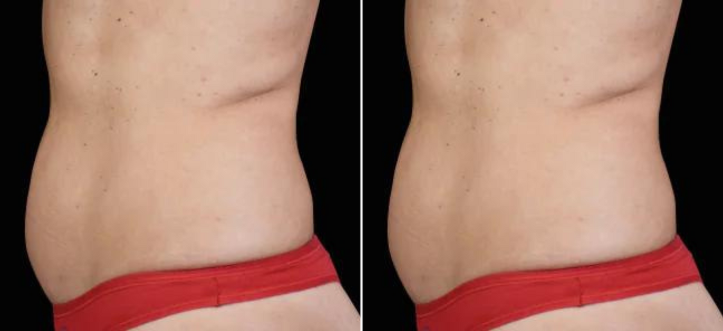 EMSculpt Neo Online Exclusive (MM)