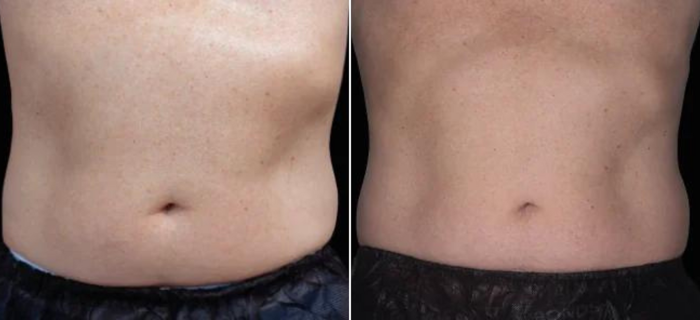 EMSculpt Neo Online Exclusive (MM)