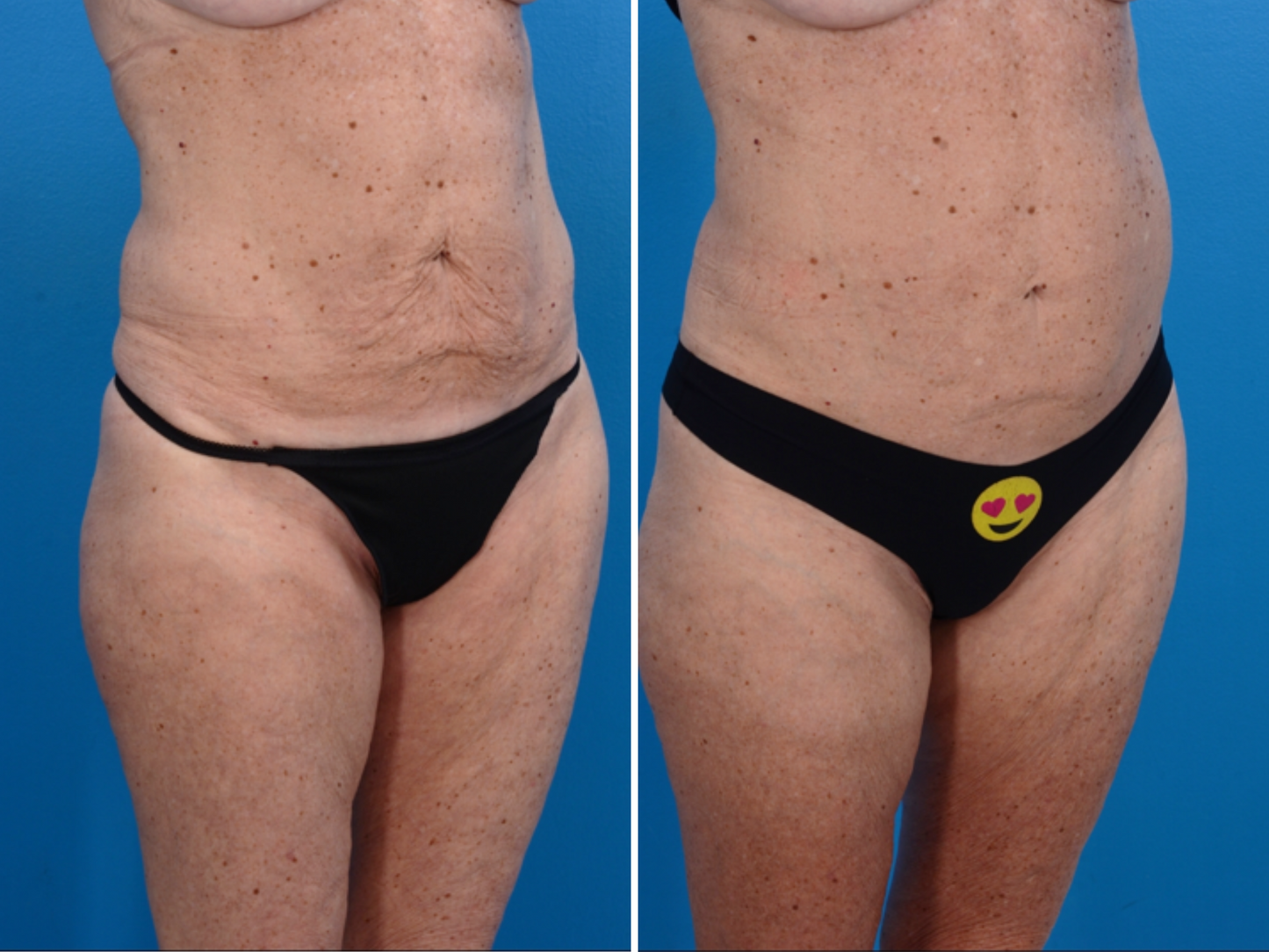 Genius Fractional RF Microneedling (MM)