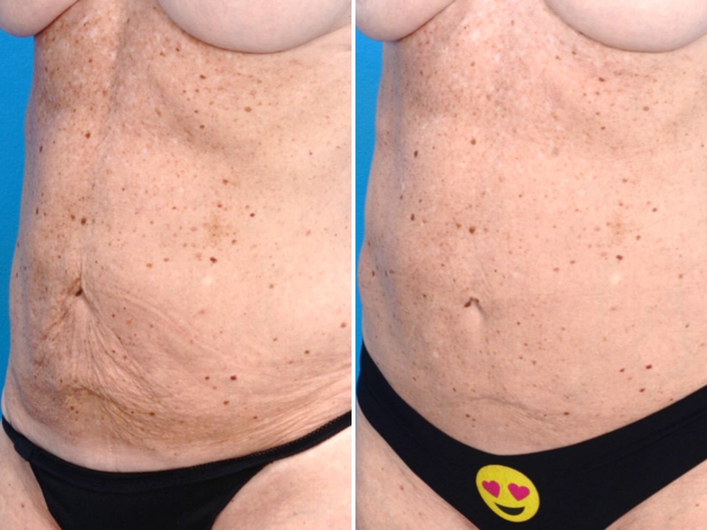 Genius Fractional RF Microneedling (MM)