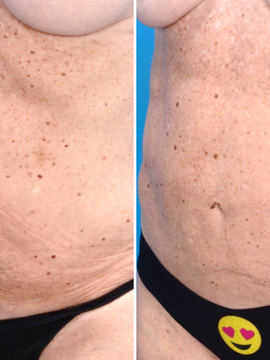 Genius Fractional RF Microneedling (MM)