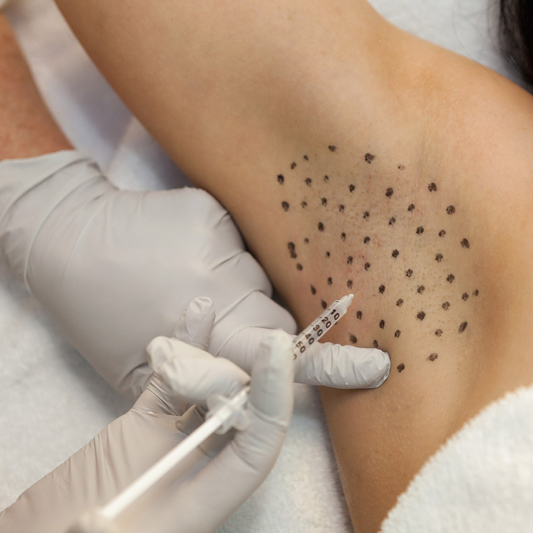 Botox injections may be used to treat severe hyperhidrosis. They block the nerves that stimulate your sweat glands.